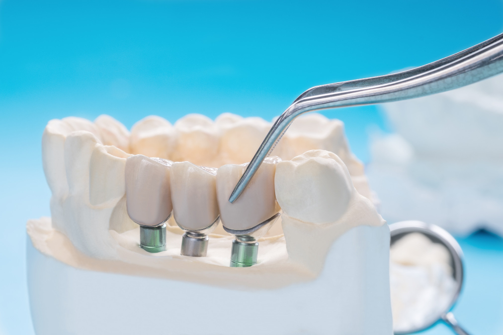 Implant-Retained Dentures in Fairfield & Cincinnati