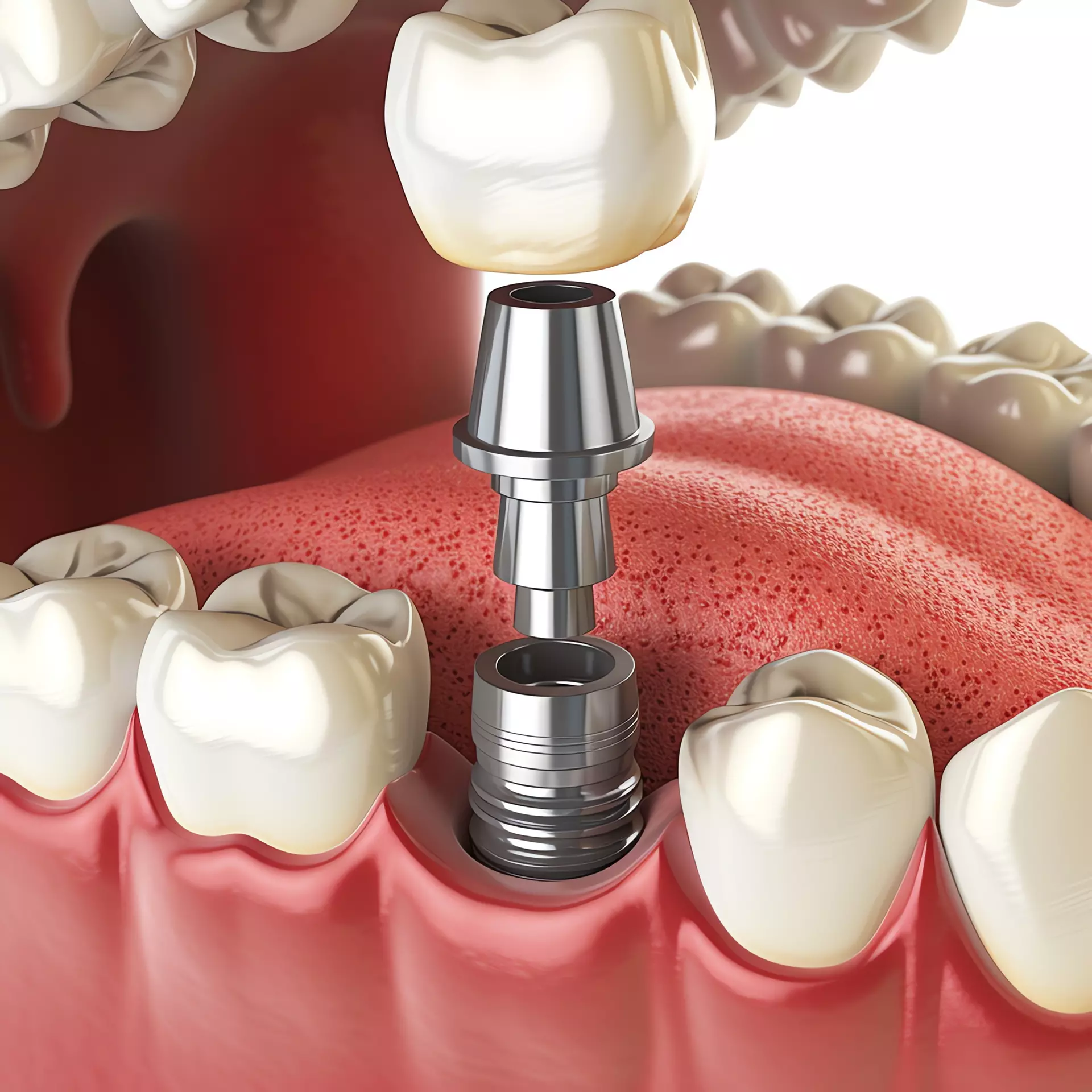 Single-Tooth Implants in Fairfield & Cincinnati