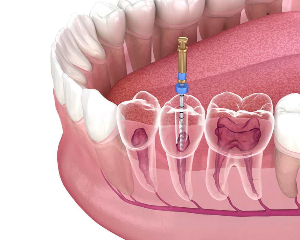 Root Canal Therapy in Fairfield & Cincinnati