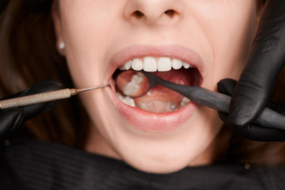 Tooth-Colored Fillings in Fairfield & Cincinnati